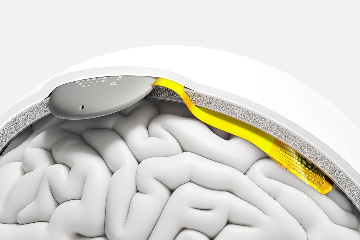 Precision Neuroscience привлекла 250 млн долларов на имплант Layer 7